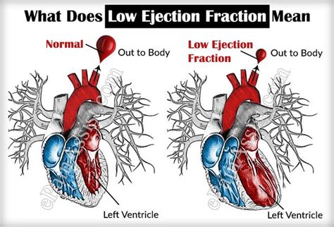 what causes low ejection fraction